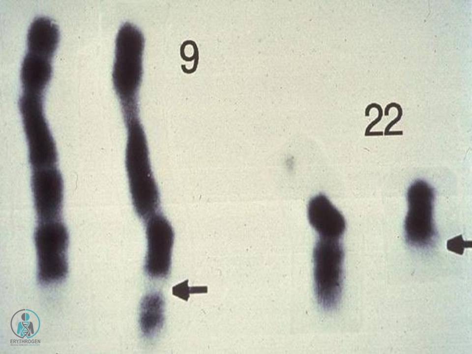 کروموزوم فیلادلفیا، که یک ناهنجاری کاریوتیپی تشخیصی برای لوسمی میلوژن مزمن است، در این تصویر از کروموزوم های نواری 9 و 22 نشان داده شده است. نتیجه انتقال متقابل 22q به بازوی تحتانی 9 و 9q است (c-abl) به یک منطقه خاص [bcr] از کروموزوم 22 که با فلش ها نشان داده شده است).