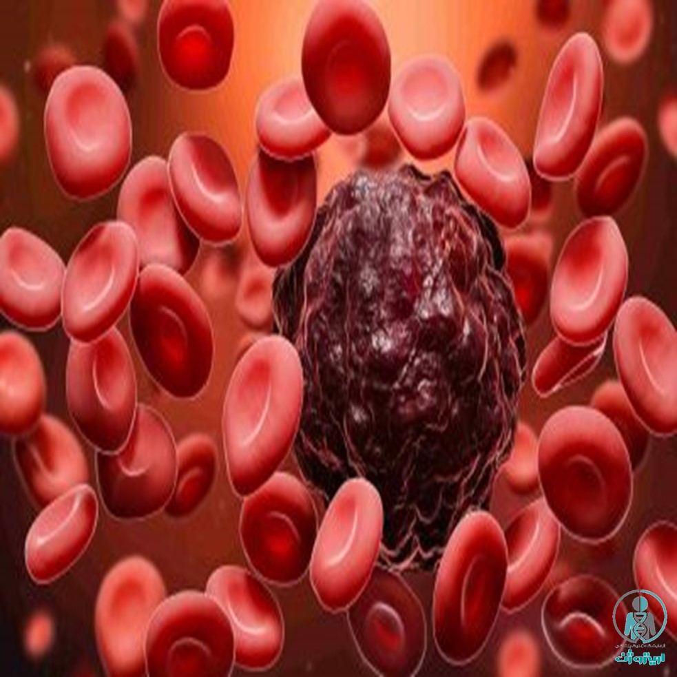 مشاوره و تشخیص سرطان خون (CML)