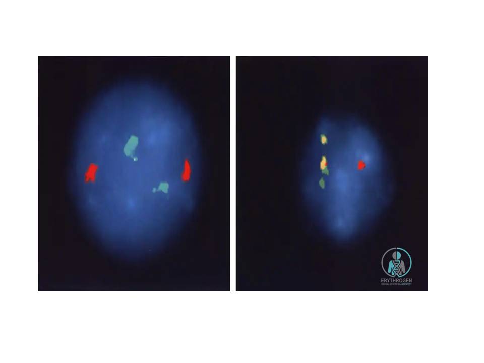 کروموزوم فیلادلفیا، که یک ناهنجاری کاریوتیپی تشخیصی برای لوسمی میلوژن مزمن است، در این تصویر از کروموزوم های 9 و 22 نشان داده شده است. نتیجه انتقال متقابل q22 به q9 است. (c-abl) به یک منطقه خاص [bcr] از کروموزوم 22 که با فلش ها نشان داده شده است.